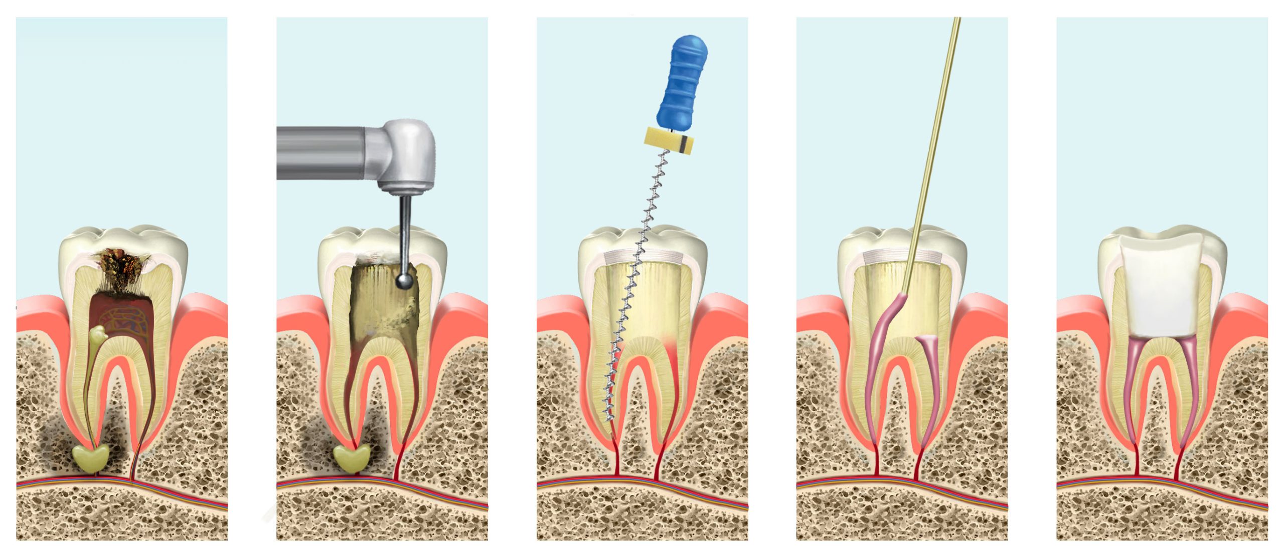 endodontics