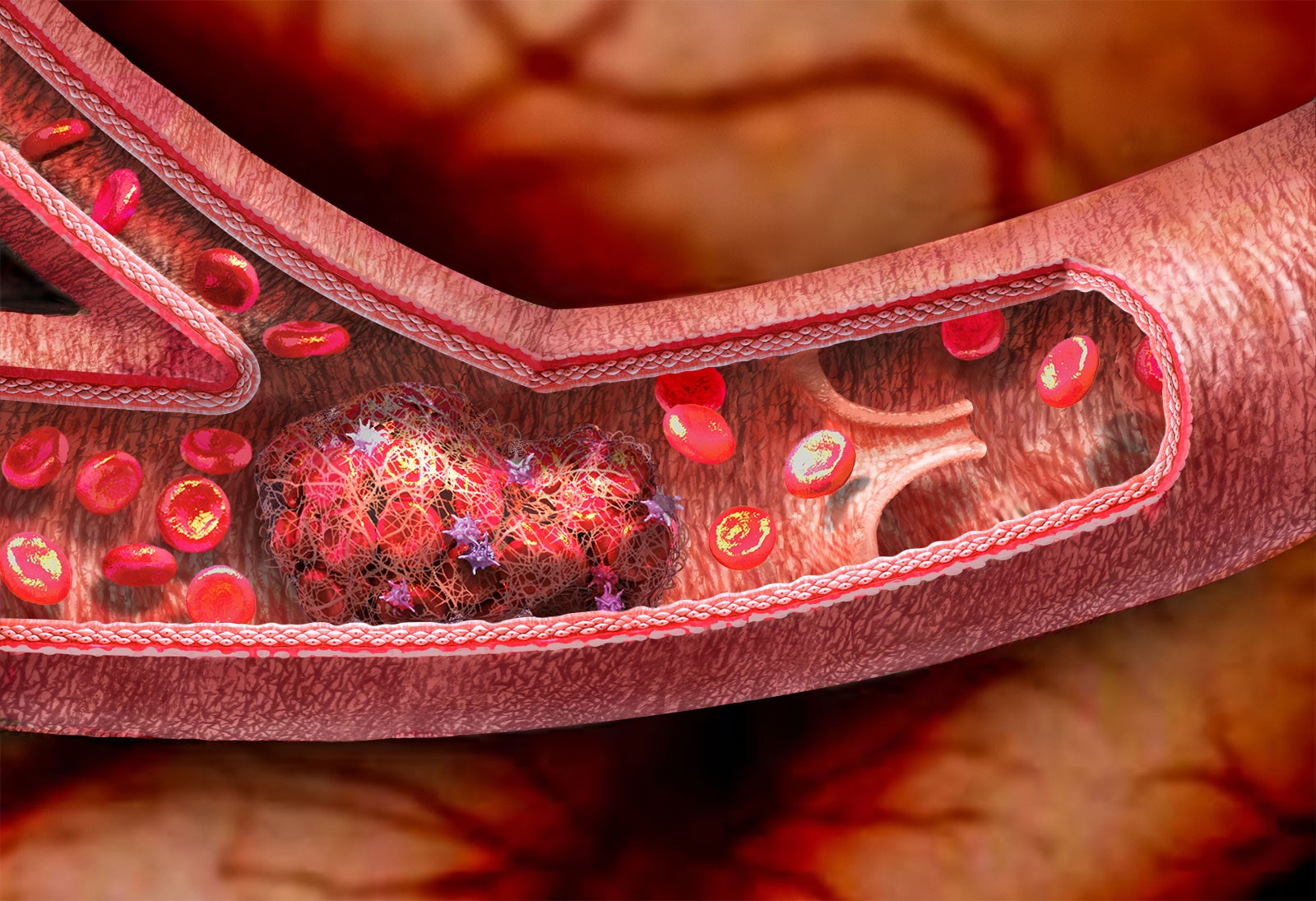 venous-thrombosis